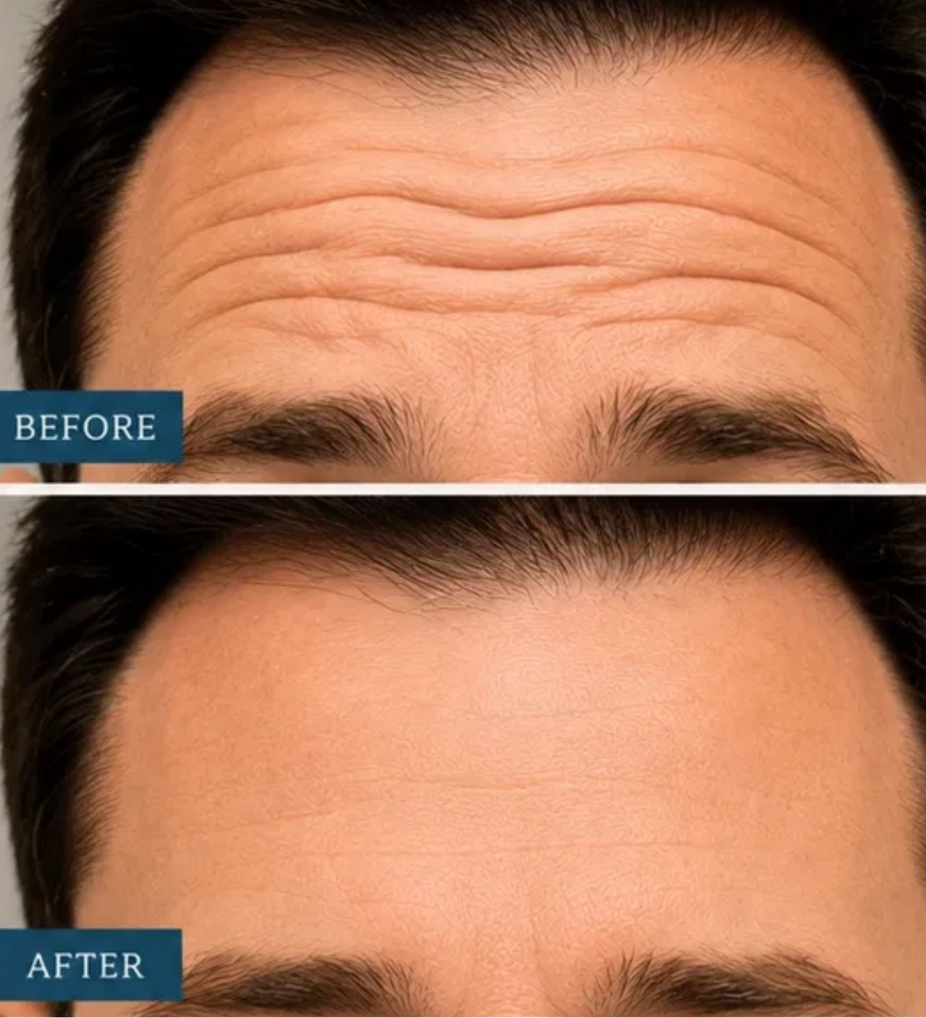 YRFB BEFORE AFTER FOREHEAD